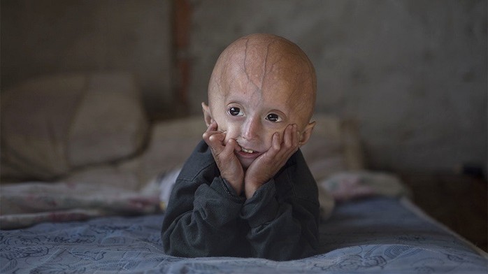 Một đứa trẻ 4 tuổi mắc chứng progeria.