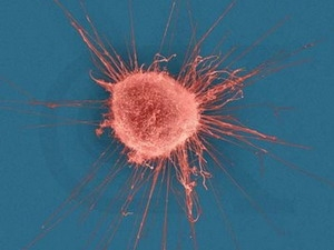 tế bào ung thư vú ( nguồn: internet)